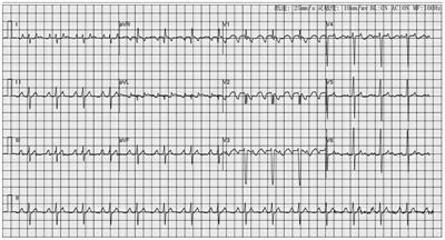 Case Report: Application of Thoracoscopic Clamp Radiofrequency Ablation on Atrial Tachycardia Originating From Right Atrial Appendage After Catheter Ablation Failure